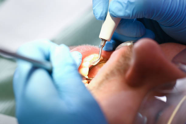 Best Emergency Dental Care for Abscessed Tooth in New Haven, MO